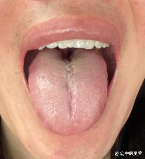 新澳正版资料大全免費和舌根和牙龈被缝一起与舌根和牙龈被缝一起怎么办